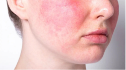 الوردية (Rosacea)